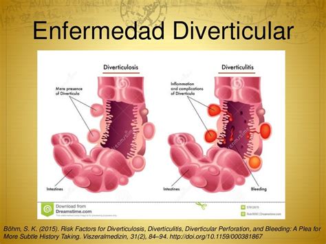 enfermedad diverticular-4